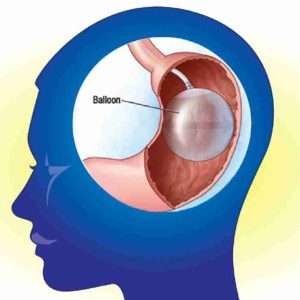 Audio - Hypno-Gastric-Balloon