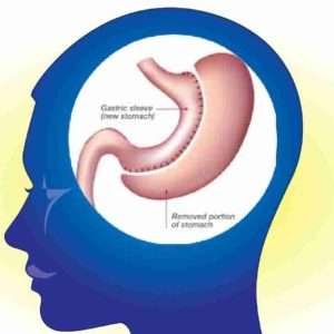 Hypno-Gastric-Sleeve